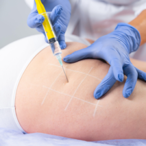 Liquid Brazilian Buttock Lift (BBL 1-to-1 Personalised Course)