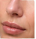 Nasolabial fold dermal filler training